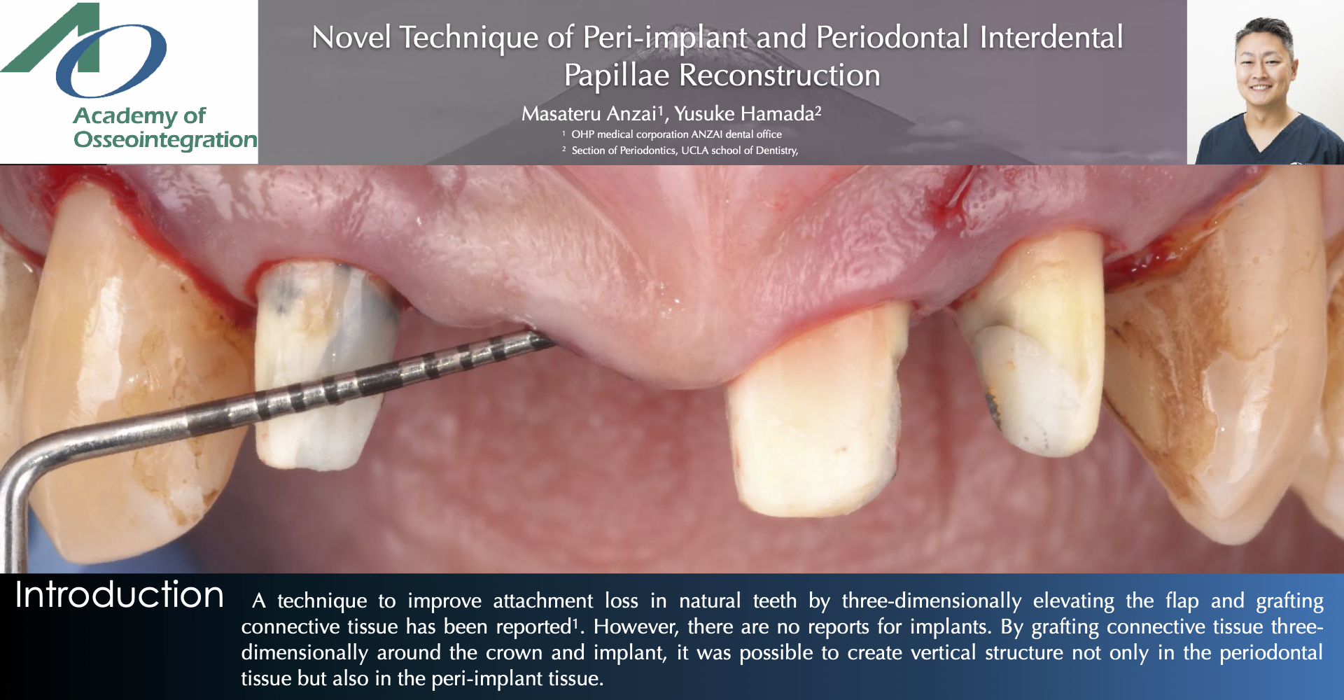 Novel Technique of Peri-implant and Periodontal Interdental Papillae Reconstruction