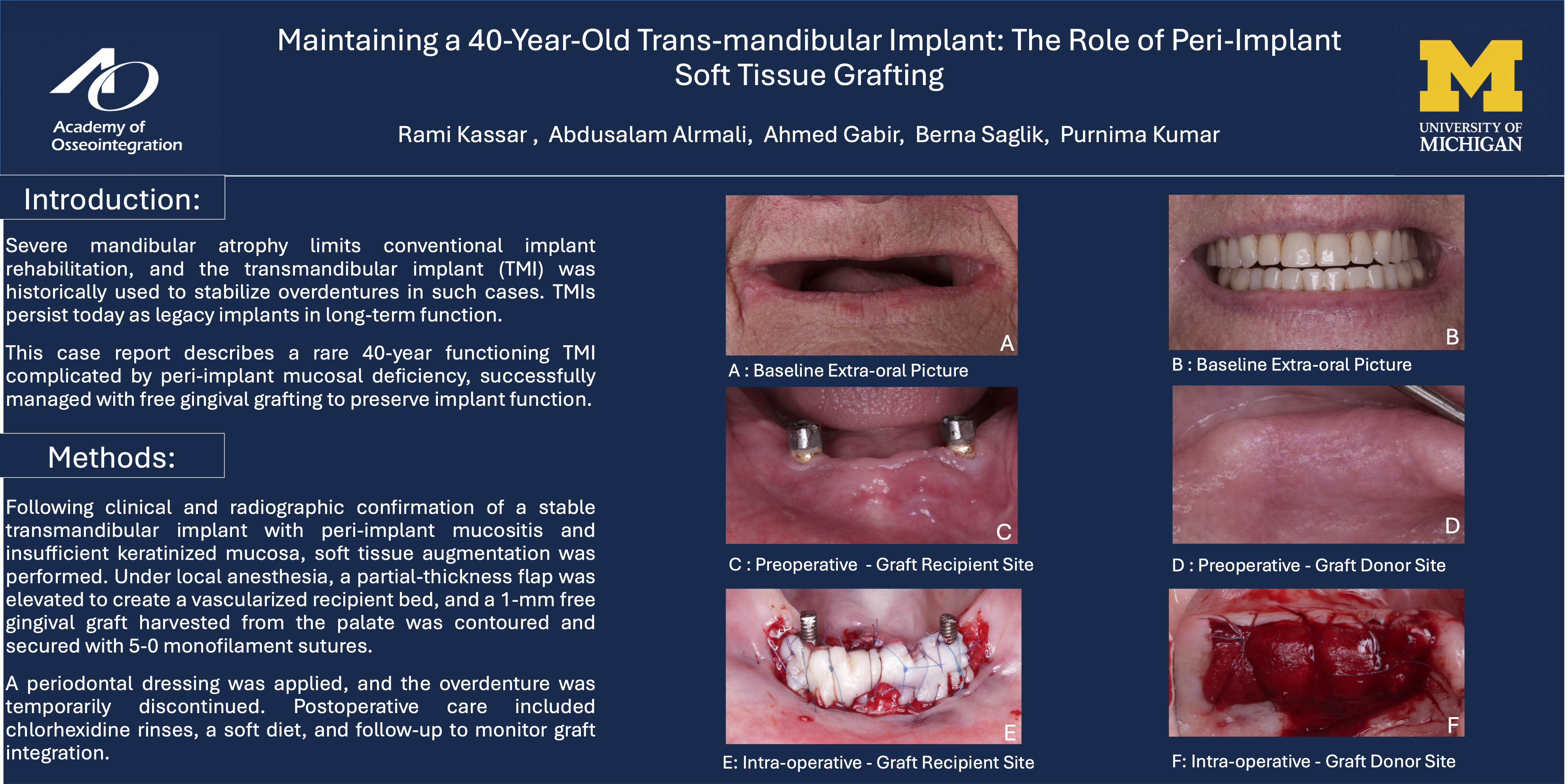 Prosthetic and Soft Tissue Optimization With a Customized Overdenture Attachment: A 40-year Journey of a Transosteal Implant