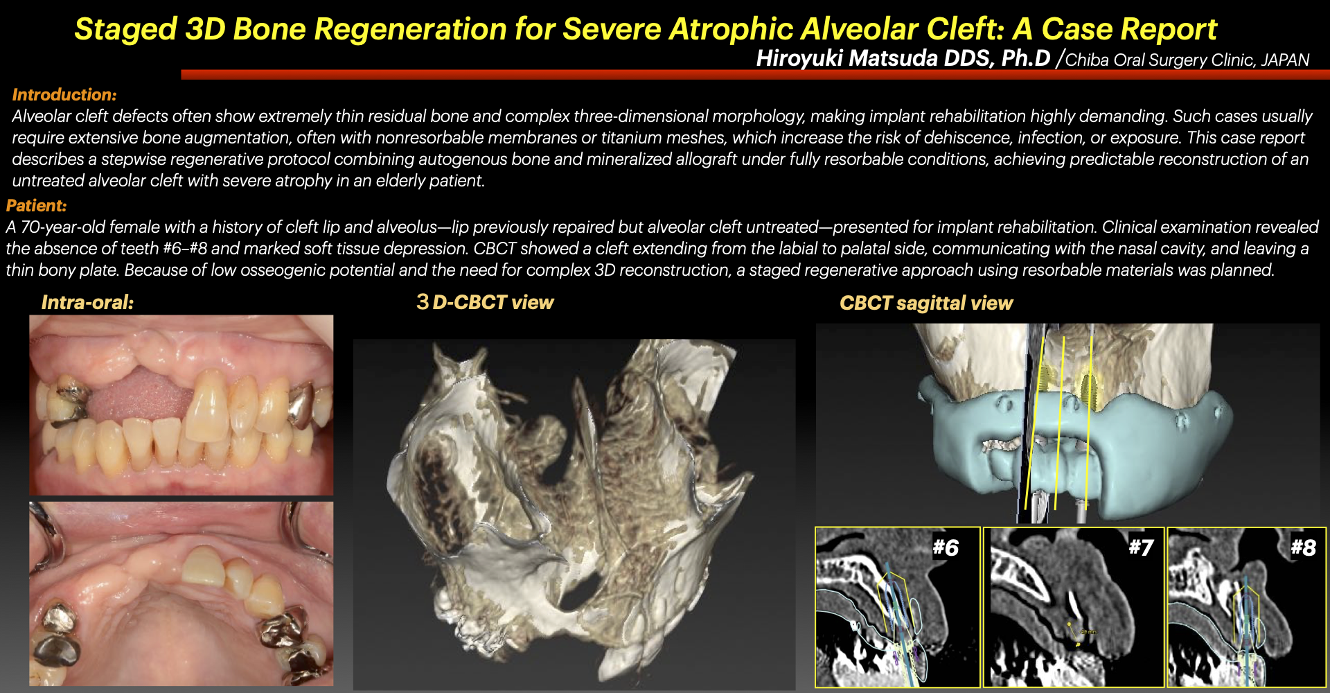 Staged 3D Bone Regeneration for Severe Atrophic Alveolar Cleft: A Case Report