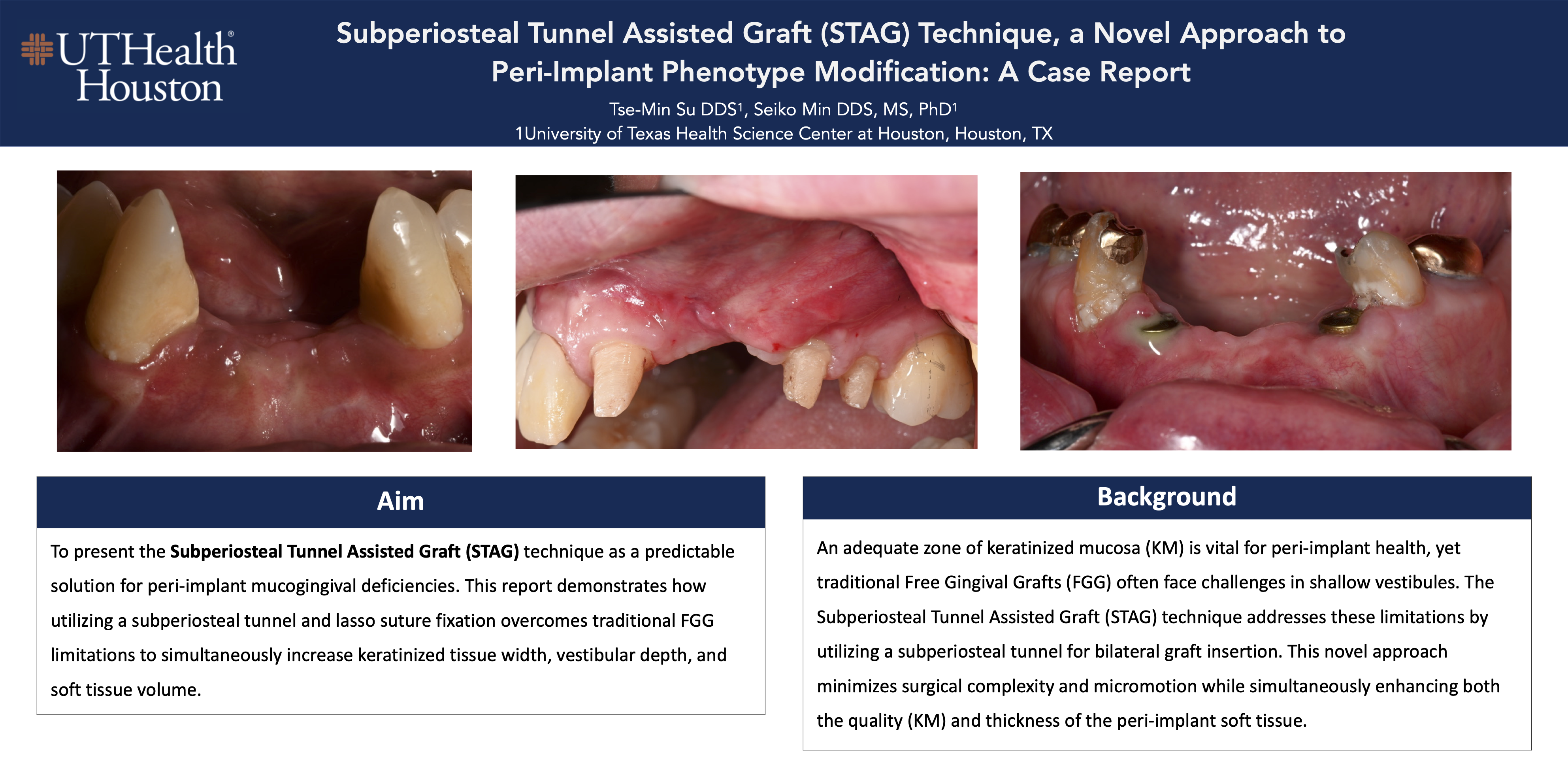 Subperiosteal Tunnel Assisted Graft (STAG) Technique, a Novel Approach to Keratinized Tissue Augmentation for Peri-Implant Mucosal Enhancement: A Case Report